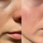 Why Menarini Tretinoin Gel Is Getting So Much Attention: Clinical Insights