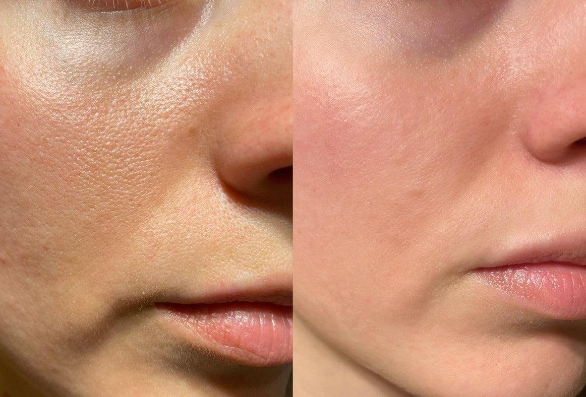 Why Menarini Tretinoin Gel Is Getting So Much Attention: Clinical Insights