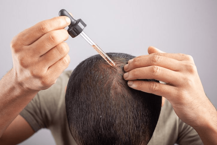 The Science of Hair Restoration: Why High-Potency Minoxidil is Changing the Game for Men